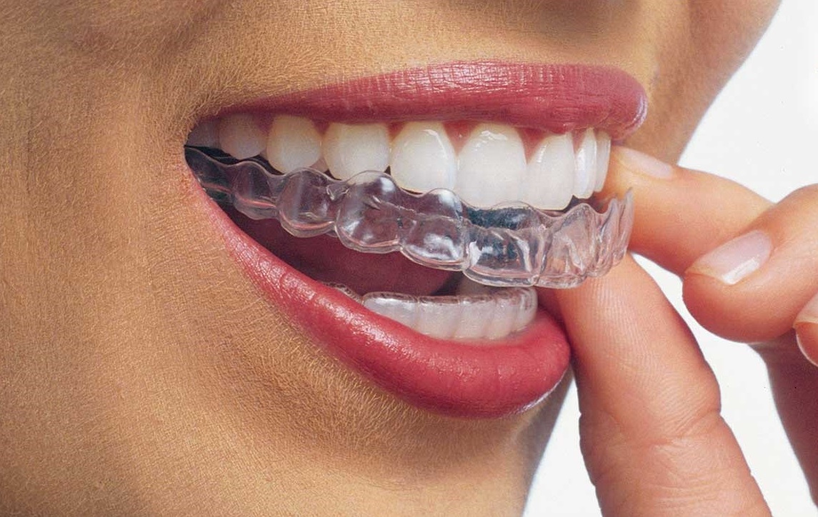 Invisalign.jpg